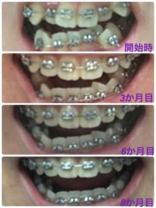 歯列矯正の経過